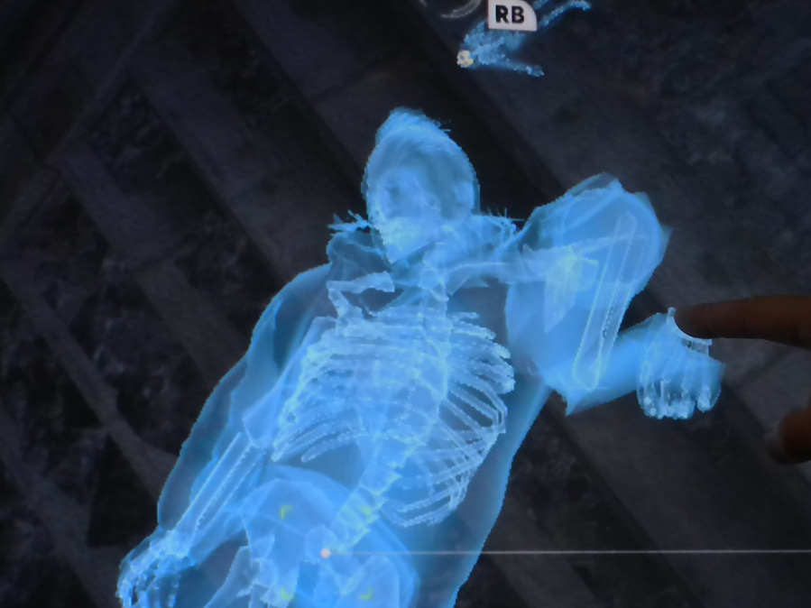 Batman Arkham City Mangled Arm